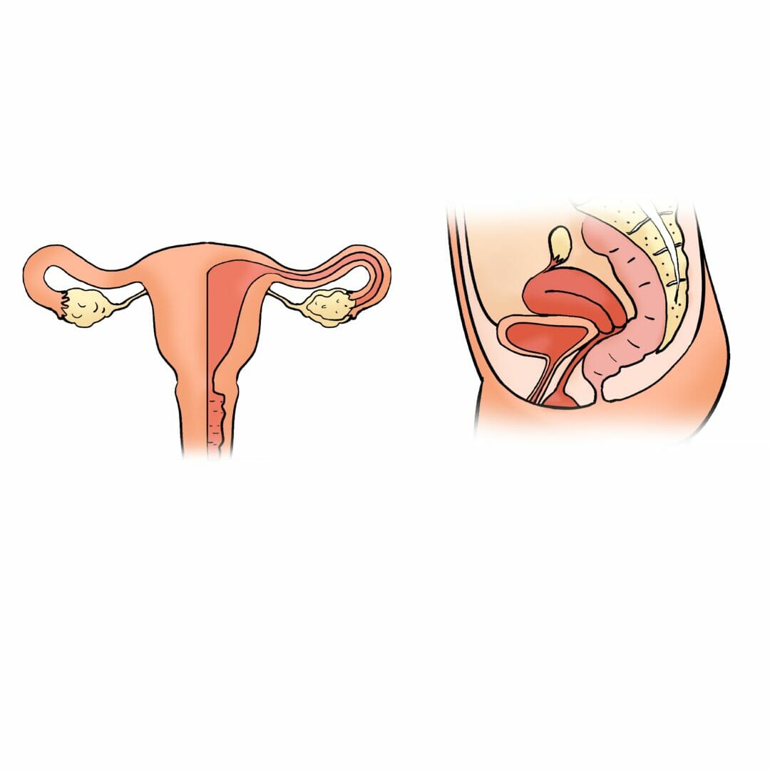 Le Cancer du Col de l'Utérus