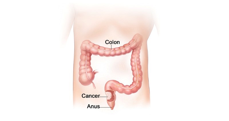 cancer du colon