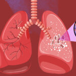 Tuberculose - infection pulmonaire