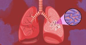 Tuberculose - infection pulmonaire