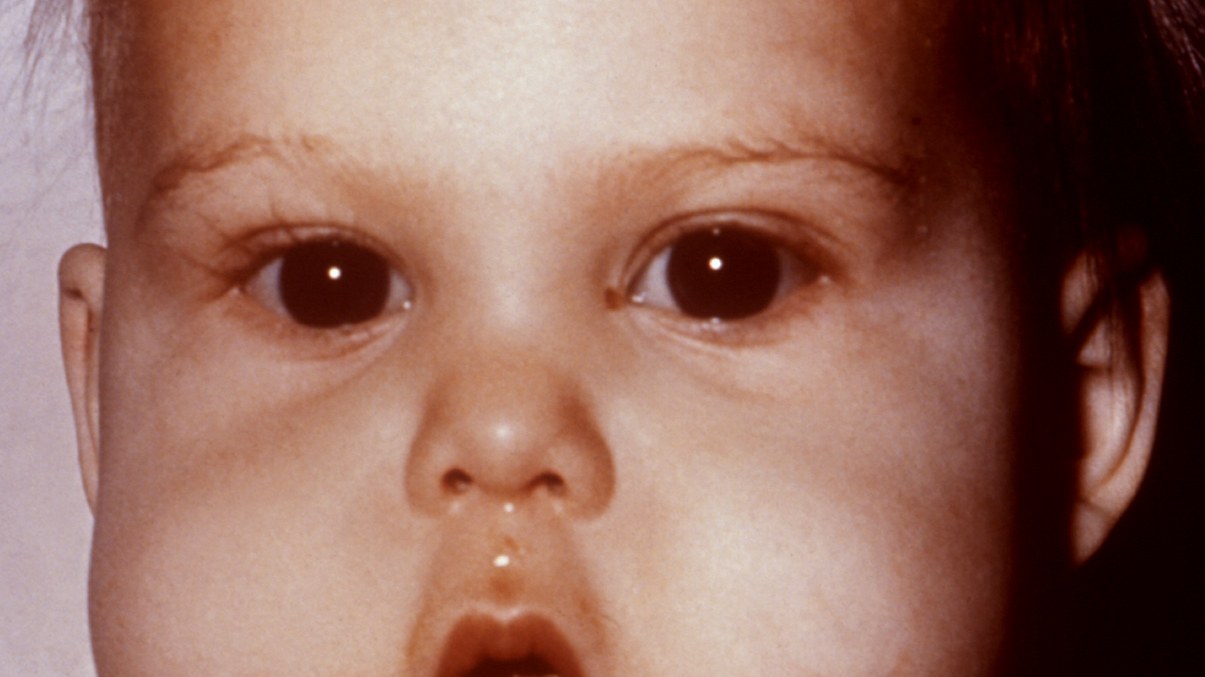 Nourrisson présentant les signes du kwashiorkor (visage). Photographie CDC/PHIL, domaine public.